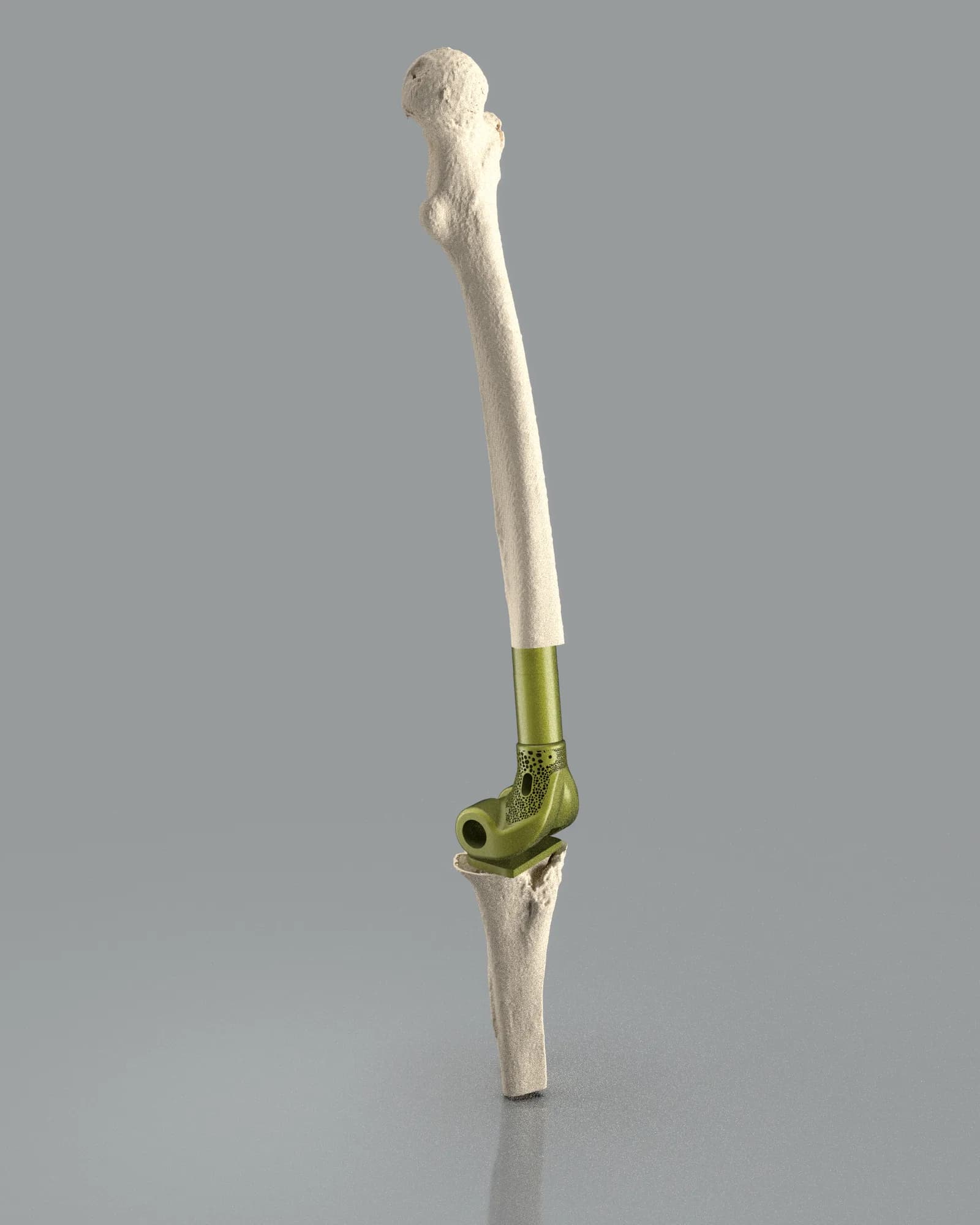 Reemplazo femoral extenso con vástago a medida articulado en la rodilla